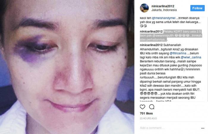 Mengejutkan, Nini Carlina Jelaskan Fakta di Balik Lebam di Wajahnya