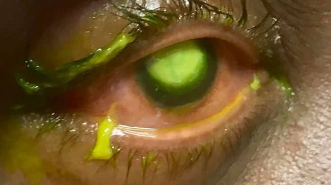 Kornea Mata Perempuan Ini Dimakan Bakteri Usai Tidur Pakai Lensa Kontak