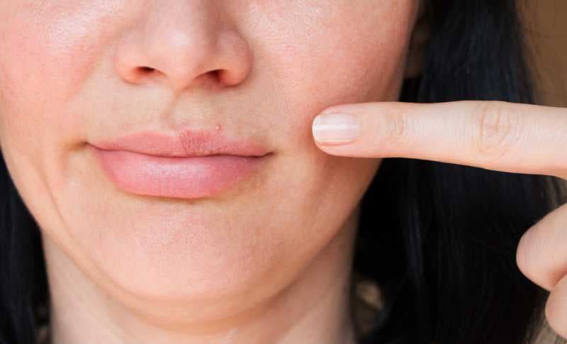 5 Kiat Mujarab untuk Membantu Mengatasi Jerawat di Bibir
